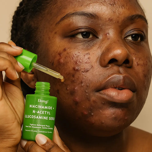 Top Ingredients for Acne-Prone Skin + Product Recommendations