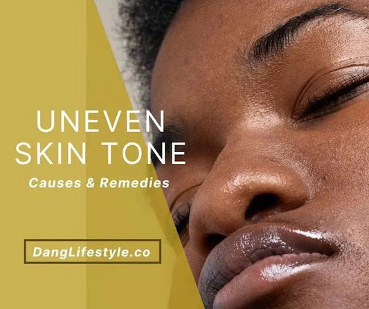 Combating Uneven Skintone: Causes and Remedies - Dang! Lifestyle Nigeria