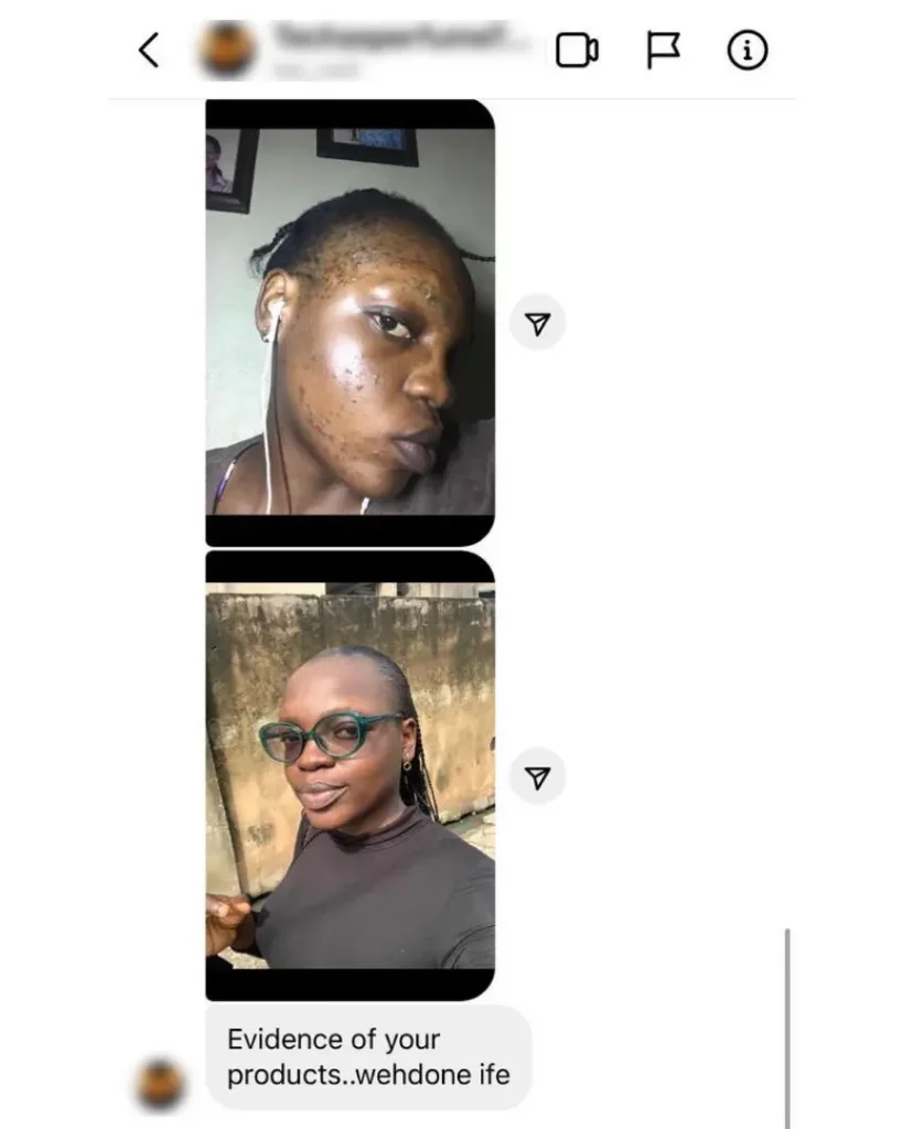 An image of the before and after image of a dark skin woman with acne breakouts who noticed improvement on her skin after using Dang! Lifestyle products