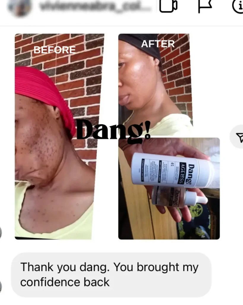 An image of the before and after pictures of a woman struggling with acne and noticed improved skin after using Dang! Lifestyle's skincare products