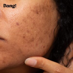 Model with dark spots on her face that will need treatment with the best acids for dark spots