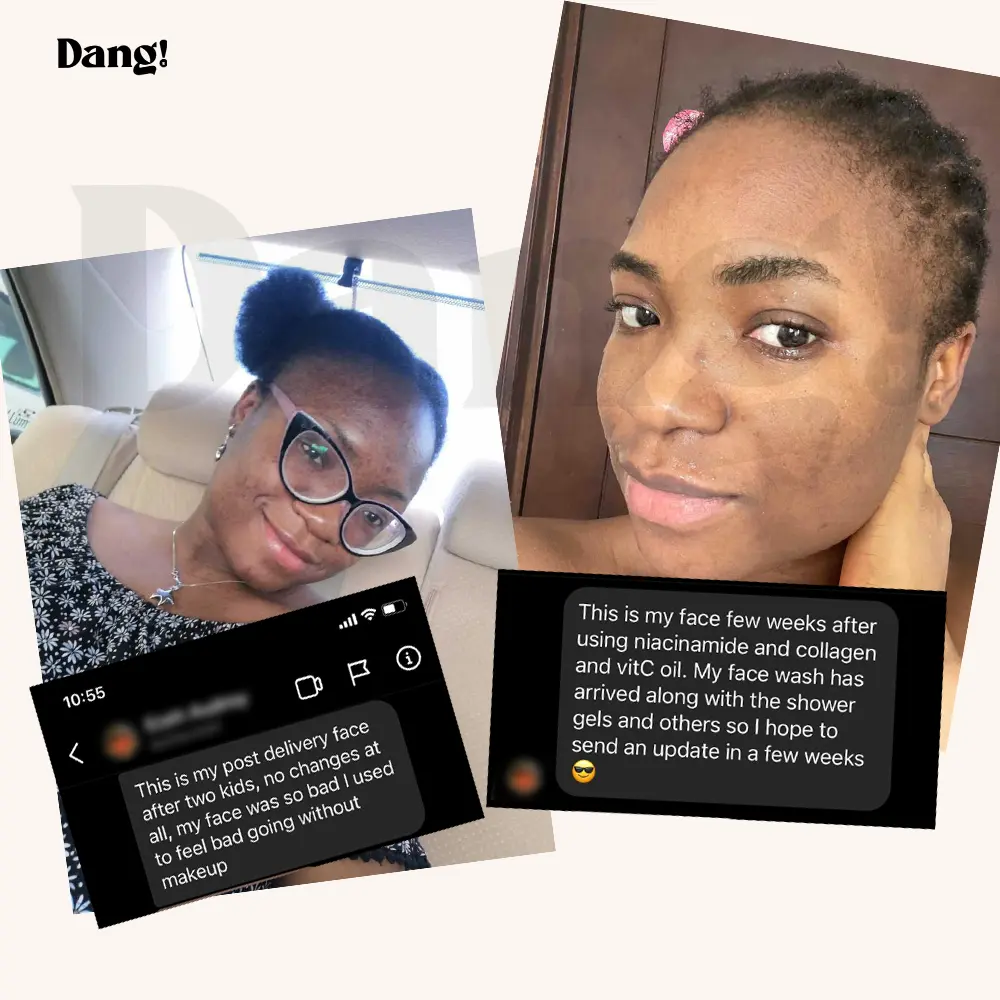 A "Before" and "after" comparison of a young woman’s face showing a reduction in acne over time, highlighting the transformation achieved with Danglifestyle skincare products.