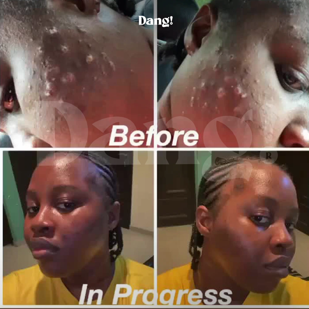 The "Before" photo of a dark skin woman with severe acne and an "In Progress" photo showing early skin improvement, a few weeks after using niacinamide, collagen, and vitamin C oil serums from Dang Lifestyle.