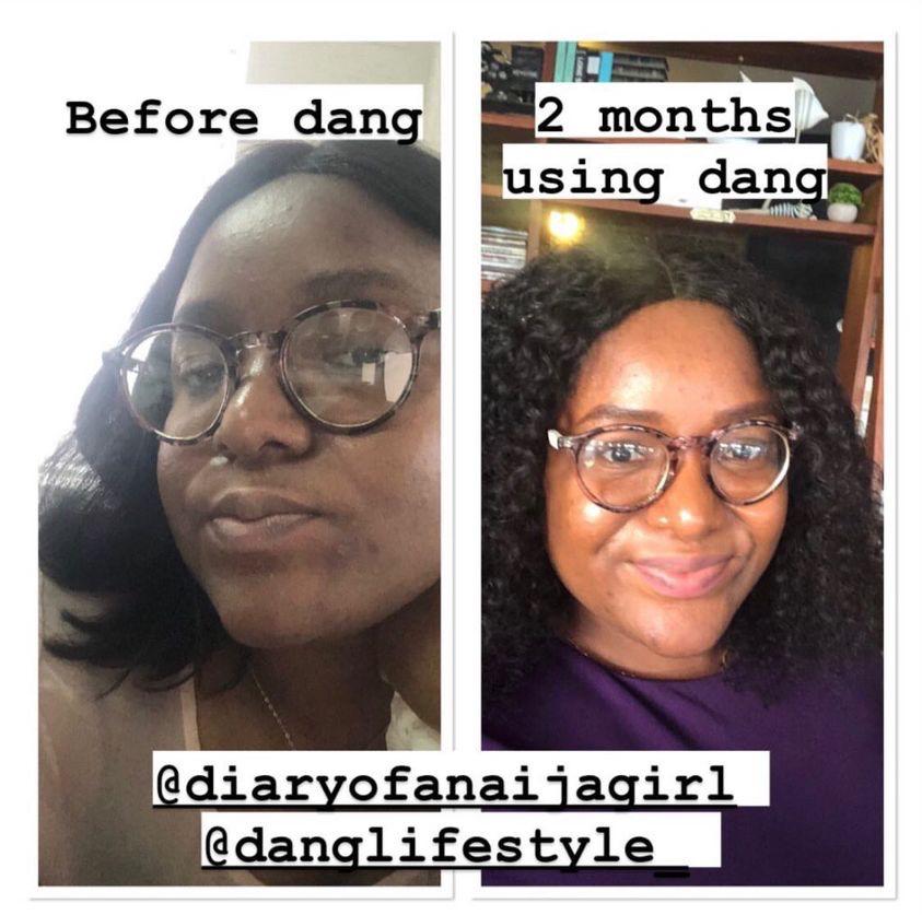 An image of a Nigerian woman with a "Before" photo of acne-prone skin and her "After" photo showing improved skin, and mentions using pregnancy-safe skincare products from Dang! Lifestyle